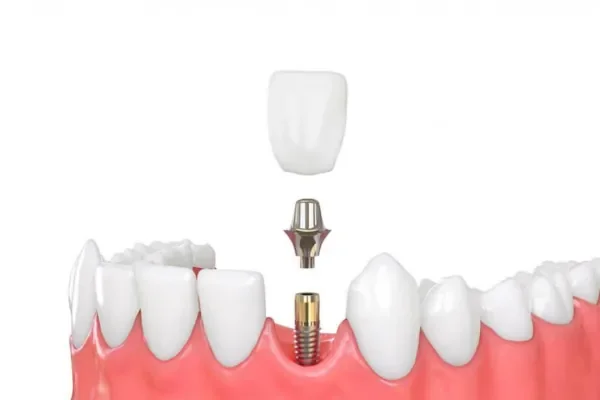 corona implantare montepulciano