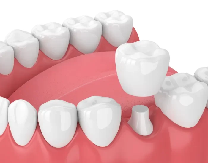 Corone dentali - studio dentistico Montepulciano