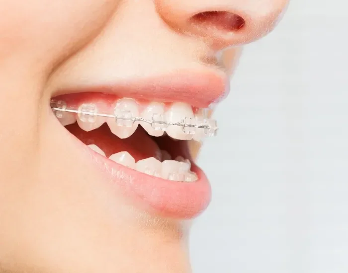 Ortodonzia tradizionale - studio dentistico Montepulciano