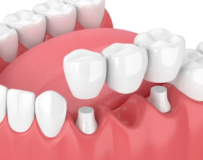 Ponti dentali