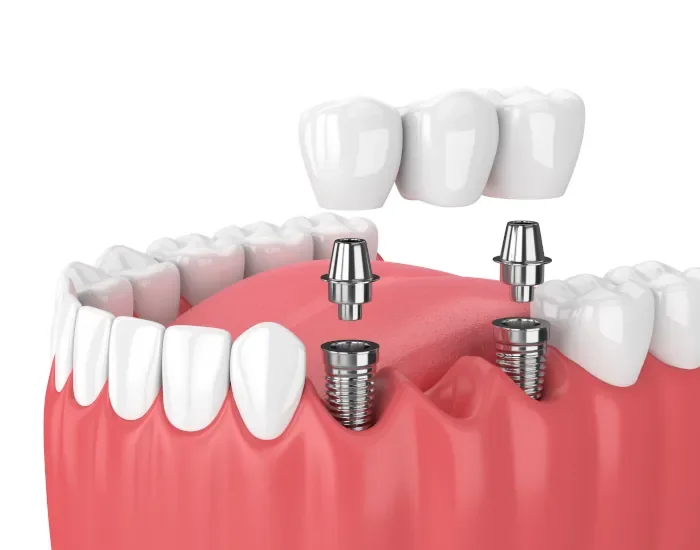 Protesi fisse sugli impianti - studio dentistico Montepulciano