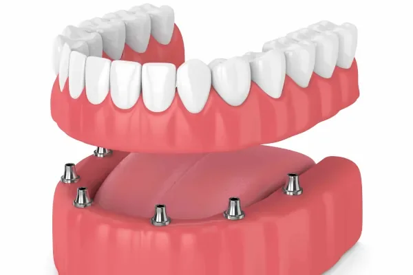 protesi totale sugli impianti montepulciano